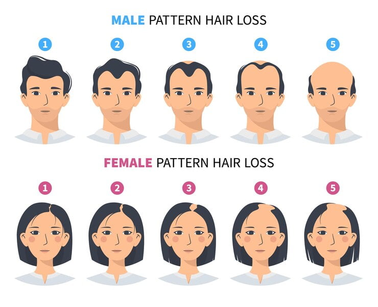 hair loss pattern in male and female their treatment 